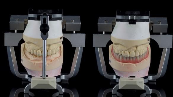 Newsletter 44 - extreme removable prosthodontics – engineering a super-strong and ultra-thin over denture