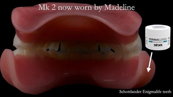 Replacing Madeline’s Complete denture FULL PROTOCOL