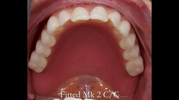 Replacing Madeline’s Complete denture FULL PROTOCOL