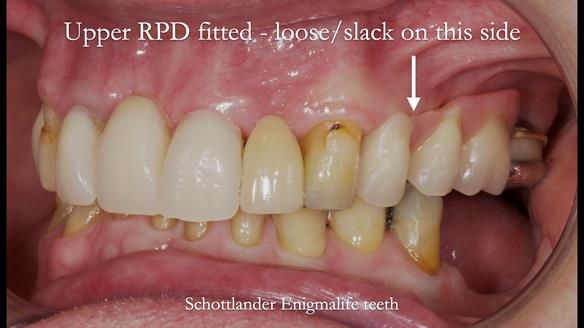 Managing Edgar “THE SCEPTIC” with an RPD/Splint FULL CASE