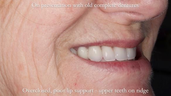 Newsletter 70 Complete Denture Treatment for Kate: A Case Study on Natural-Looking Dentures and Implant-Supported Overdentures