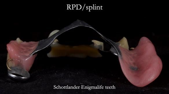 Managing Edgar “THE SCEPTIC” with an RPD/Splint FULL CASE