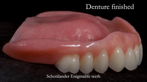 Newsletter 70 Complete Denture Treatment for Kate: A Case Study on Natural-Looking Dentures and Implant-Supported Overdentures