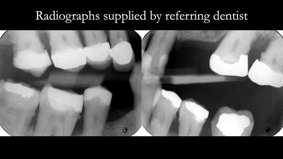 Read Newsletter 67 - Brian's COMBAT DENTURE Case Study