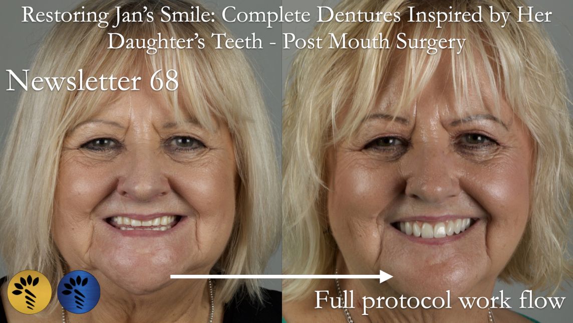 Study Club Live 4 Restoring Jan’s Smile: Complete Dentures Inspired by Her Daughter - Finlay Sutton