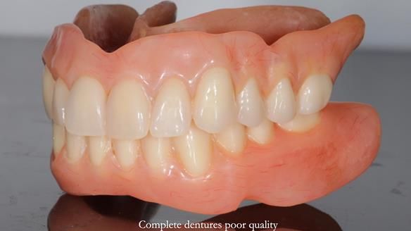 Newsletter 65 Marisa Provision of Complete Dentures on badly placed implants