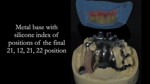 How Keith’s combat denture transformed his life – Newsletter 73