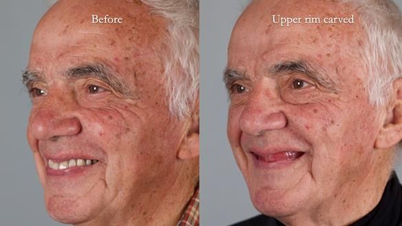 Newsletter 74: Ken’s Case Study Complete Dentures - Life Like and Age Appropriate