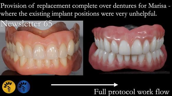 Newsletter 65 Marisa Provision of Complete Dentures on badly placed implants