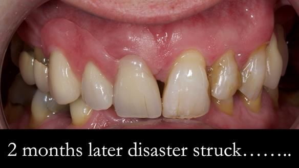 Read Newsletter 67 - Brian's COMBAT DENTURE Case Study