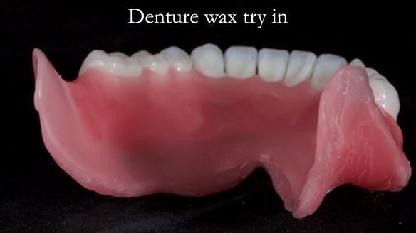 Newsletter 65 Marisa Provision of Complete Dentures on badly placed implants