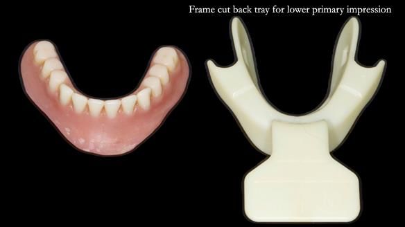 Newsletter 68 Restoring Jan’s Smile: Complete Dentures Inspired by Her Daughter’s Teeth - Post Mouth Surgery