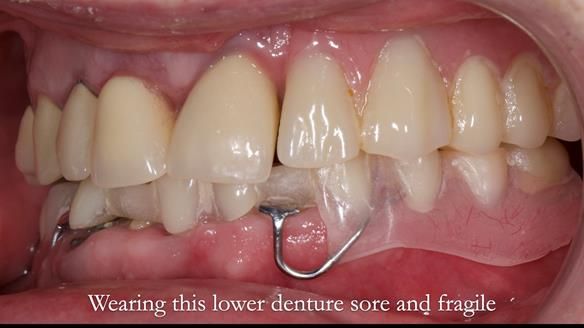 Newsletter 44 - extreme removable prosthodontics – engineering a super-strong and ultra-thin over denture