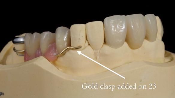 Managing Edgar “THE SCEPTIC” with an RPD/Splint FULL CASE