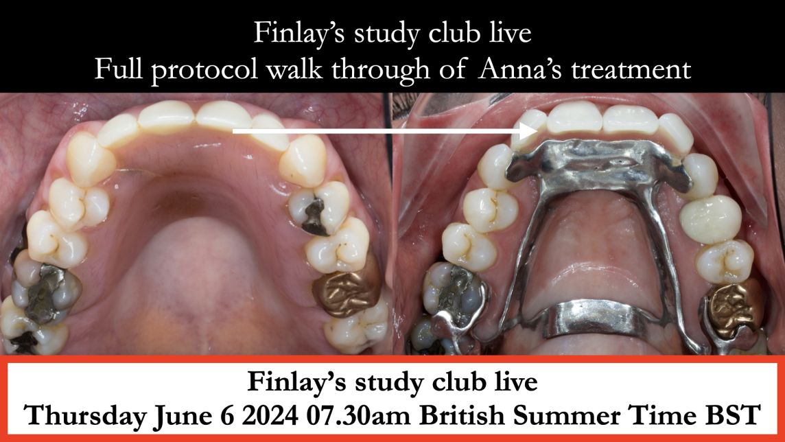 Study Club Live 2 Highly aesthetic Kennedy Class IV for Anna - 11 year follow up - Finlay Sutton