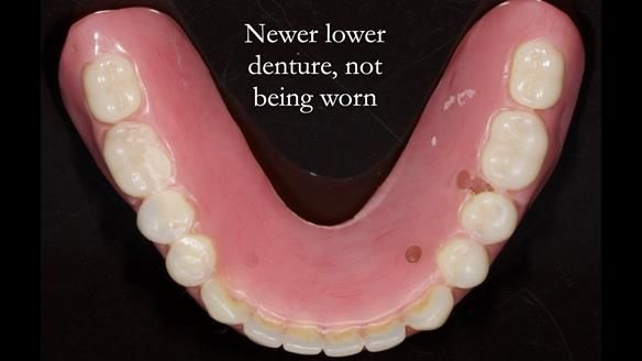 Newsletter 44 - extreme removable prosthodontics – engineering a super-strong and ultra-thin over denture