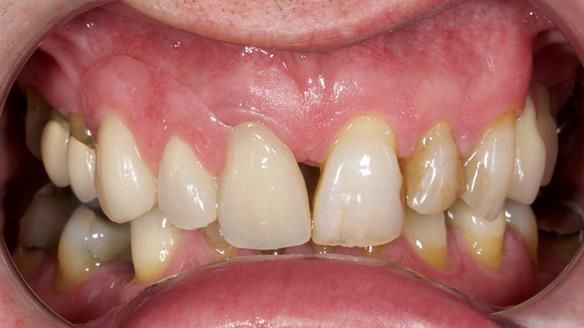 Read Newsletter 67 - Brian's COMBAT DENTURE Case Study