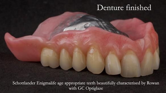 Newsletter 74: Ken’s Case Study Complete Dentures - Life Like and Age Appropriate