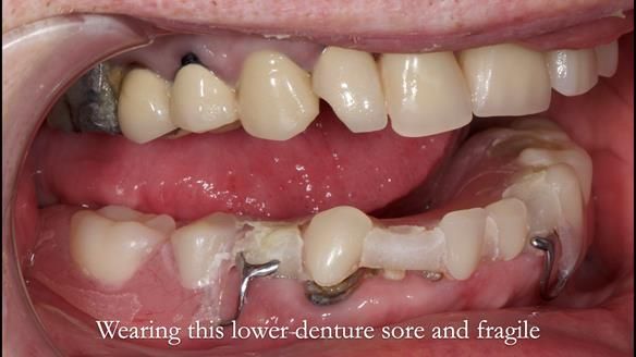 Newsletter 44 - extreme removable prosthodontics – engineering a super-strong and ultra-thin over denture