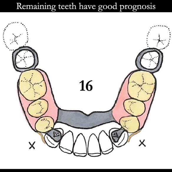 Universal Scandinavian partial denture designs