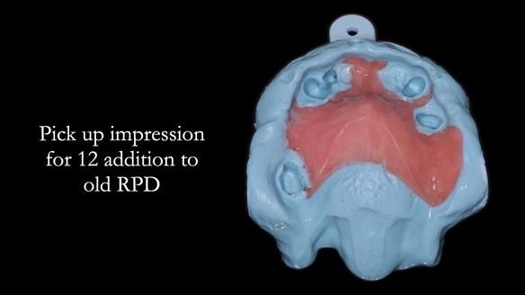 Managing Edgar “THE SCEPTIC” with an RPD/Splint FULL CASE