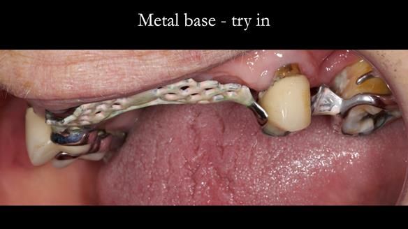 Eileen's transformation with upper and lower RPDs of Scandinavian hygienic design FULL PROTOCOL