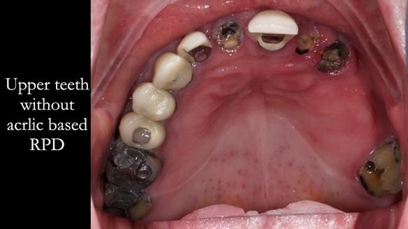 Newsletter 44 - extreme removable prosthodontics – engineering a super-strong and ultra-thin over denture