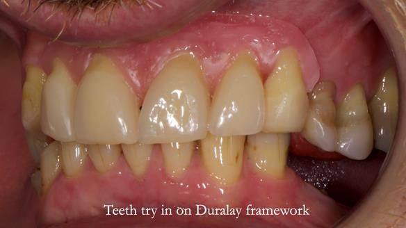 How Keith’s combat denture transformed his life – Newsletter 73