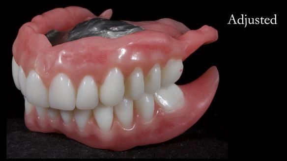 Newsletter 65 Marisa Provision of Complete Dentures on badly placed implants