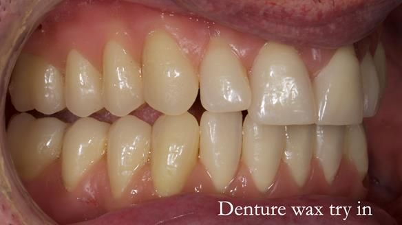 Newsletter 74: Ken’s Case Study Complete Dentures - Life Like and Age Appropriate