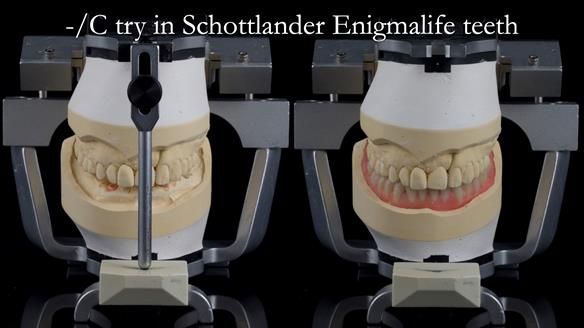 Newsletter 44 - extreme removable prosthodontics – engineering a super-strong and ultra-thin over denture