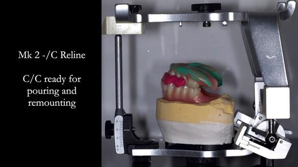 Replacing Madeline’s Complete denture FULL PROTOCOL