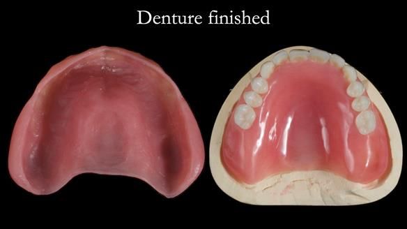 Newsletter 70 Complete Denture Treatment for Kate: A Case Study on Natural-Looking Dentures and Implant-Supported Overdentures