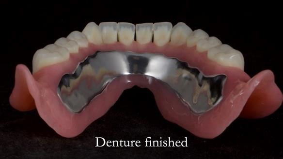 Newsletter 70 Complete Denture Treatment for Kate: A Case Study on Natural-Looking Dentures and Implant-Supported Overdentures