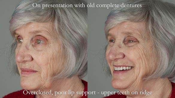 Newsletter 70 Complete Denture Treatment for Kate: A Case Study on Natural-Looking Dentures and Implant-Supported Overdentures