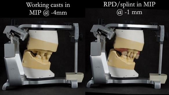 Newsletter 71 Jean’s Class I Mod III RPD: See my mistakes Fractured Mk1 to a Stronger Mk2 RPD (4 years on)