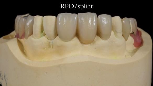 Managing Edgar “THE SCEPTIC” with an RPD/Splint FULL CASE