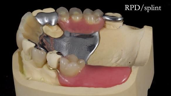 Managing Edgar “THE SCEPTIC” with an RPD/Splint FULL CASE