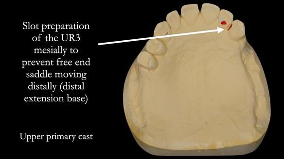 Solving Sue's failed implants with metal based RPD - full protocol Newsletter 43