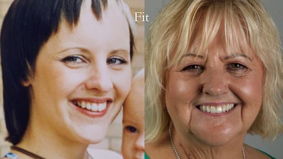 Newsletter 68 Restoring Jan’s Smile: Complete Dentures Inspired by Her Daughter’s Teeth - Post Mouth Surgery