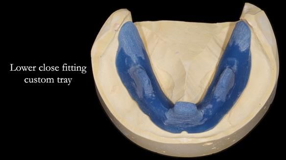 Newsletter 70 Complete Denture Treatment for Kate: A Case Study on Natural-Looking Dentures and Implant-Supported Overdentures