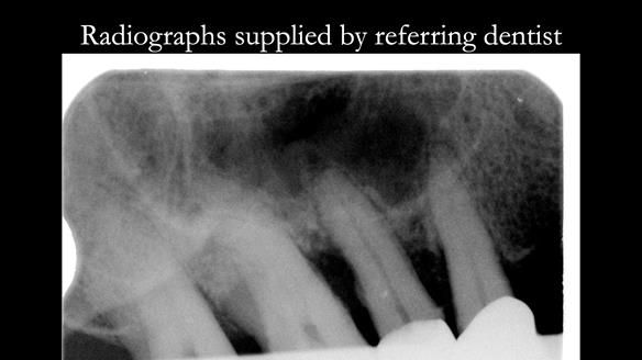 Read Newsletter 67 - Brian's COMBAT DENTURE Case Study