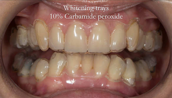  Figure 52 tooth-whitening trays made to fit over natural teeth and dentures