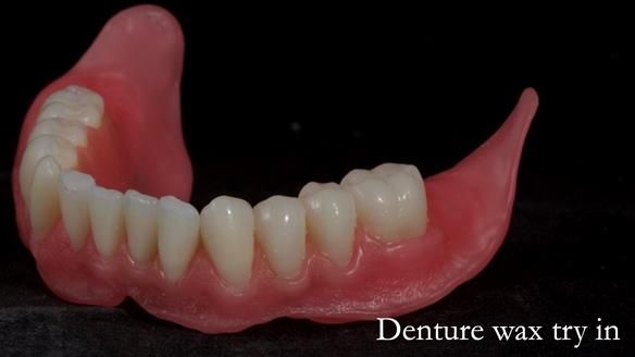 Newsletter 70 Complete Denture Treatment for Kate: A Case Study on Natural-Looking Dentures and Implant-Supported Overdentures