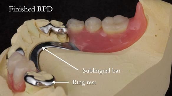 Eileen's transformation with upper and lower RPDs of Scandinavian hygienic design FULL PROTOCOL