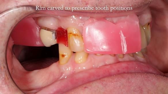 Managing Edgar “THE SCEPTIC” with an RPD/Splint FULL CASE