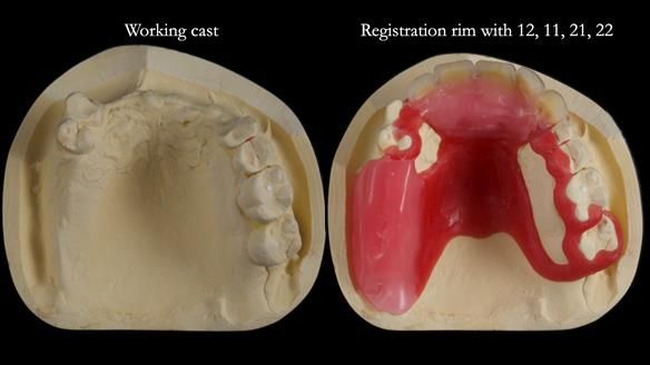 How Keith’s combat denture transformed his life – Newsletter 73