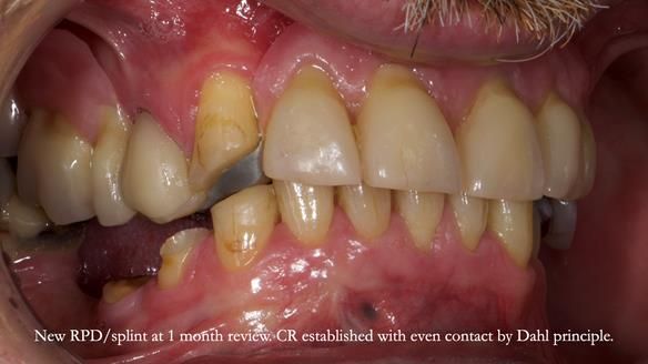 How Keith’s combat denture transformed his life – Newsletter 73