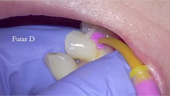  Figure 61 Grade 2 mobile LR4 would move in the impression. To avoid this it was temporarily stabilised with a composite splint and Futar D blocked out underneath to prevent impression tearing