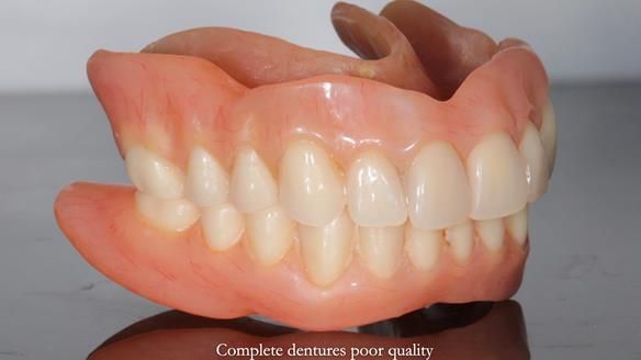 Newsletter 65 Marisa Provision of Complete Dentures on badly placed implants